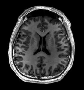MRI scan showing a healthy human brain