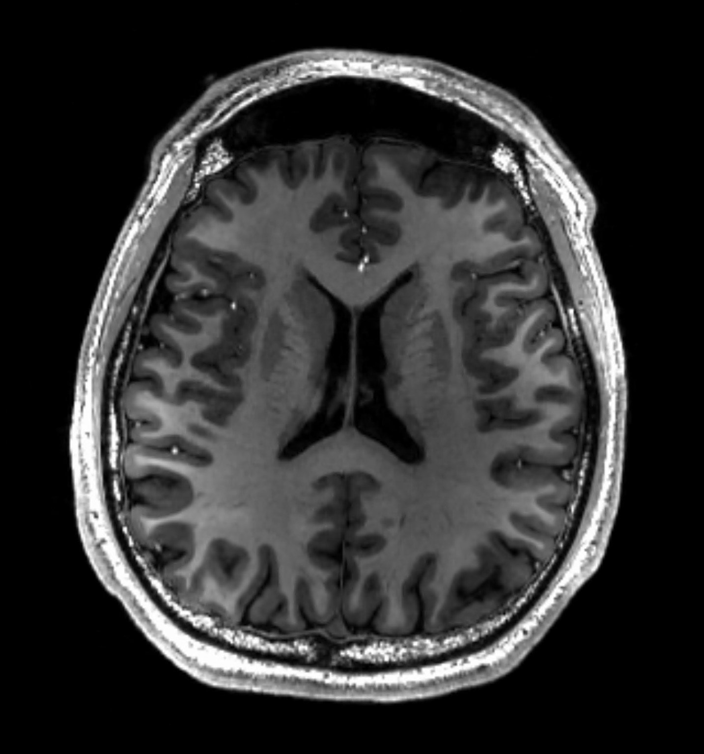 MRI scan showing a healthy human brain